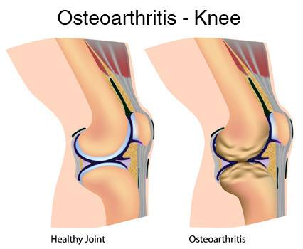 osteoarthritis victoria bc