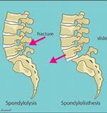 Spondylolysis and Spondylolisthesis
