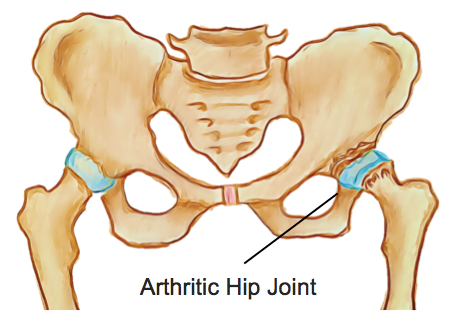 osteoarthritis hip physiotherapy victoria bc