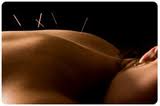Acupuncture Treatment Shelbourne Physiotherapy Victoria BC