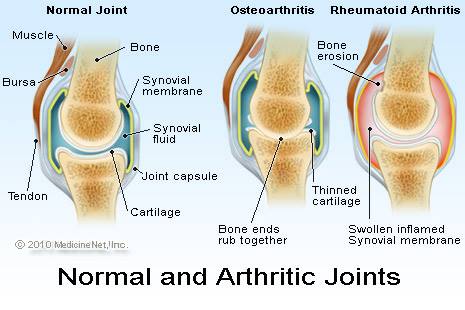 arthritis victoria bc shelbourne physio