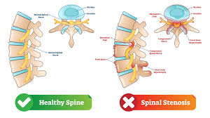Victoria spinal stenosis